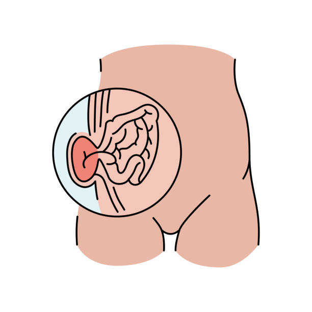 strangulated hernia line icon. vector isolated element. editable stroke.